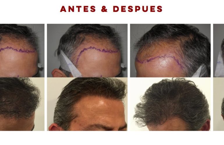 Tratamiento de la alopecia